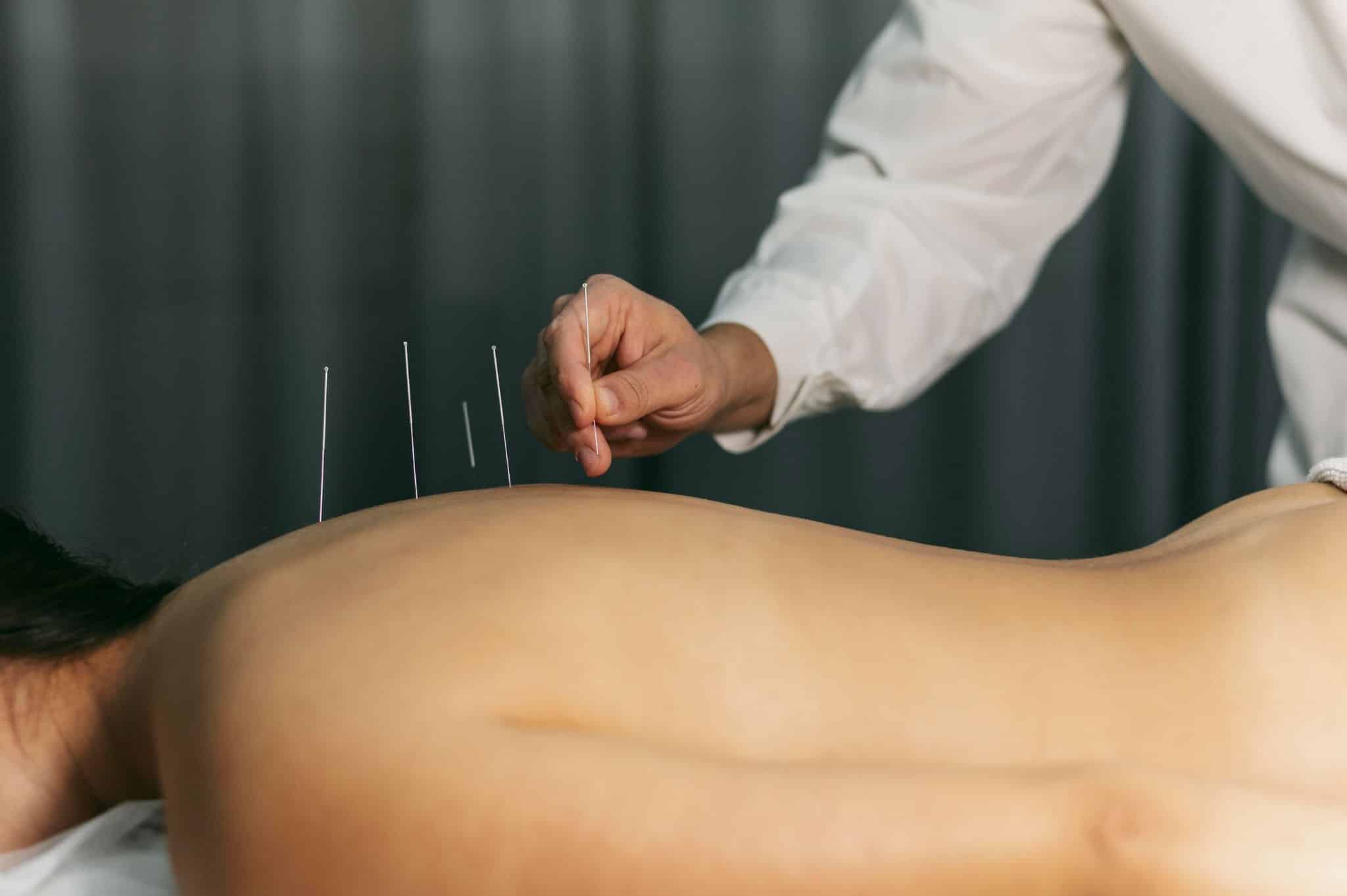 An acupuncturist placing fine needles in a woman's back.