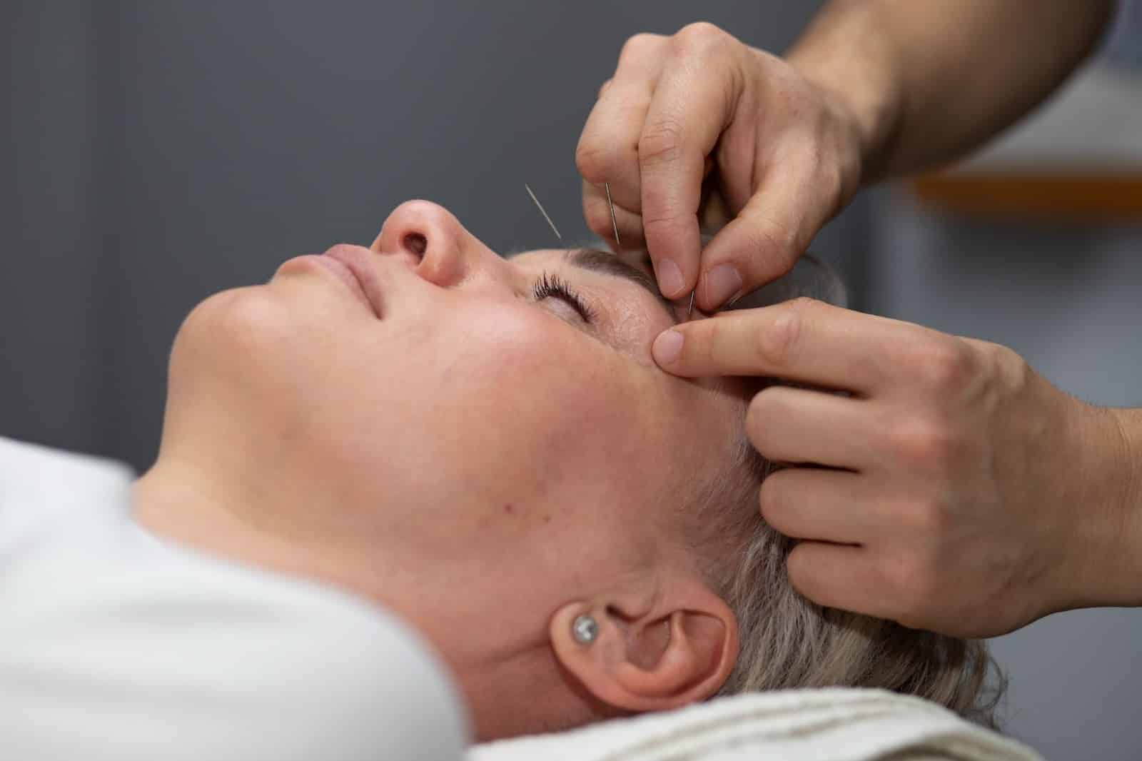 An acupuncturist inserting needles into a woman's head to treat her headaches.